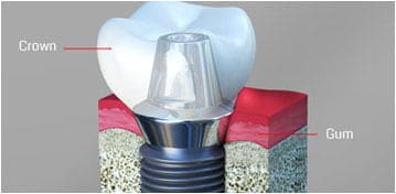 Dental Implants Woodbridge Township