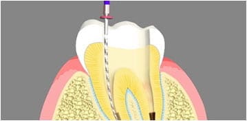 Root Canal Treatment Woodbridge Township