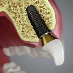 7 Ways to Take Care of Dental Implants | Woodbridge NJ