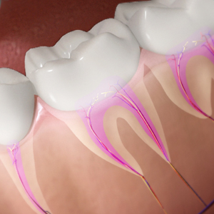 7 Tips to Take Care of Root Canal Treatment | Woodbridge NJ