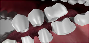 Dental Bridges Fords NJ