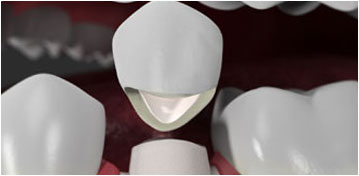 Dental Crowns Fords NJ