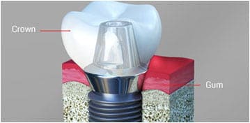 Dental Implants Fords NJ