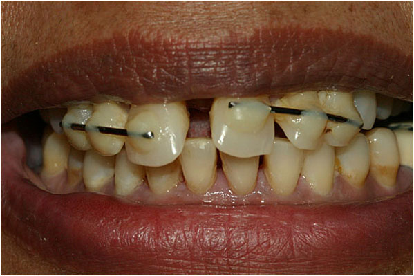 Dental Implants Before