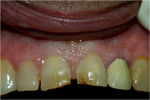 Dental Crowns Before 